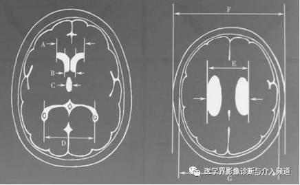 脑室顶间外径;   f:头颅最大外径a:前角间最大径;    b:前角间最小径